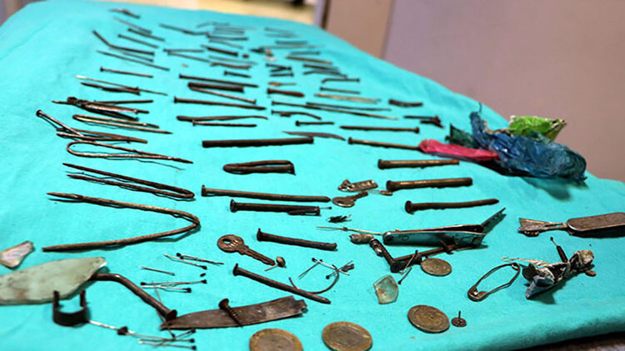 Mide değil nalbur dükkanı! 158 parça gören doktorlar şaşkına döndü