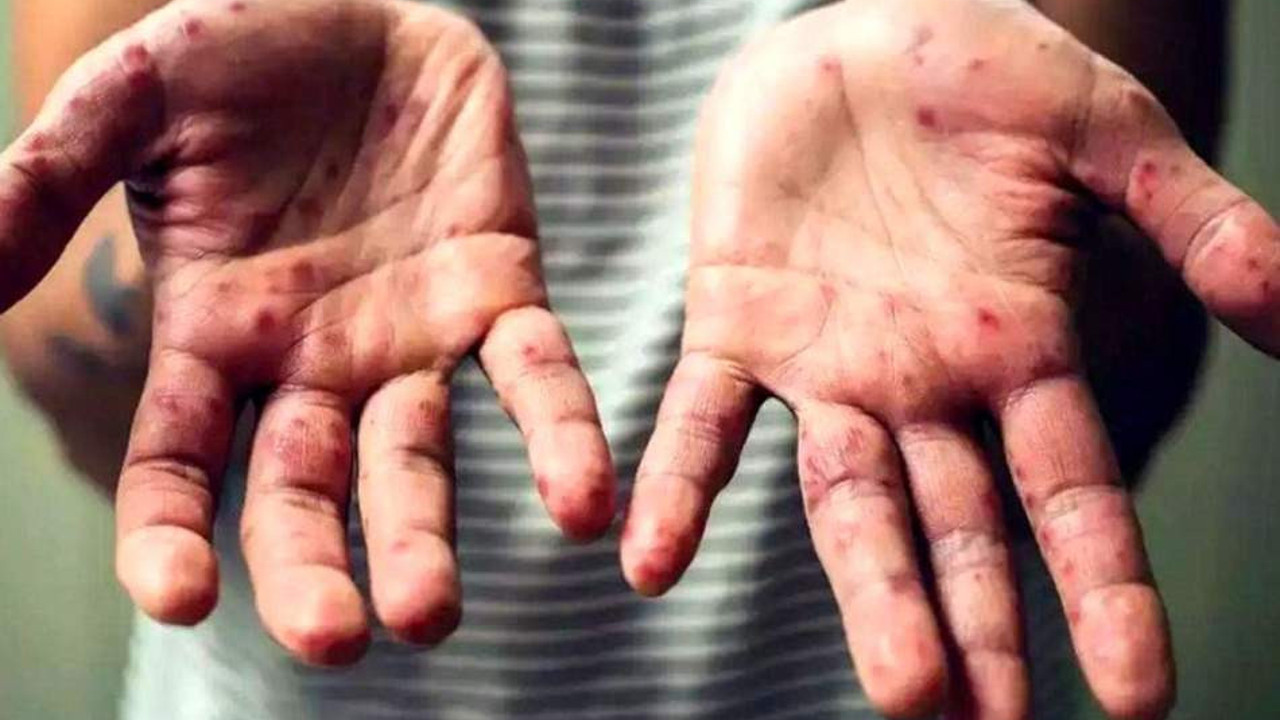 Fransa Sağlık Bakanı'ndan maymun çiçeği açıklaması: Genel hasta profili eşcinsel erkekler