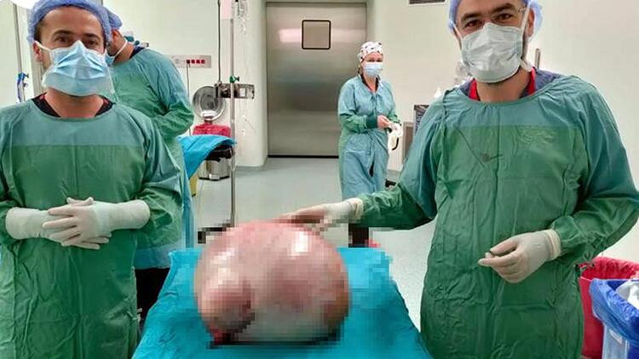 Karın şişliği şikâyetiyle hastaneye gitti. Karnından 35 kiloluk kitle çıkarıldı