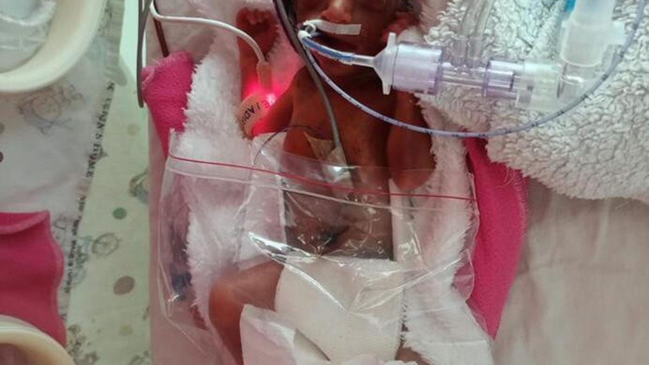 710 gram doğan Arden bebek, hayata nasıl tutundu?