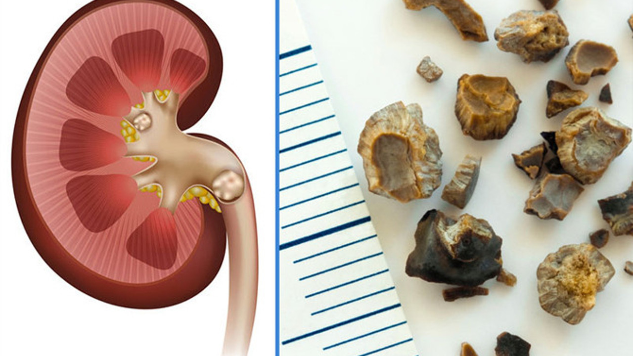 İşte böbrek taşı üreten besinler (23 Kasım 2022)