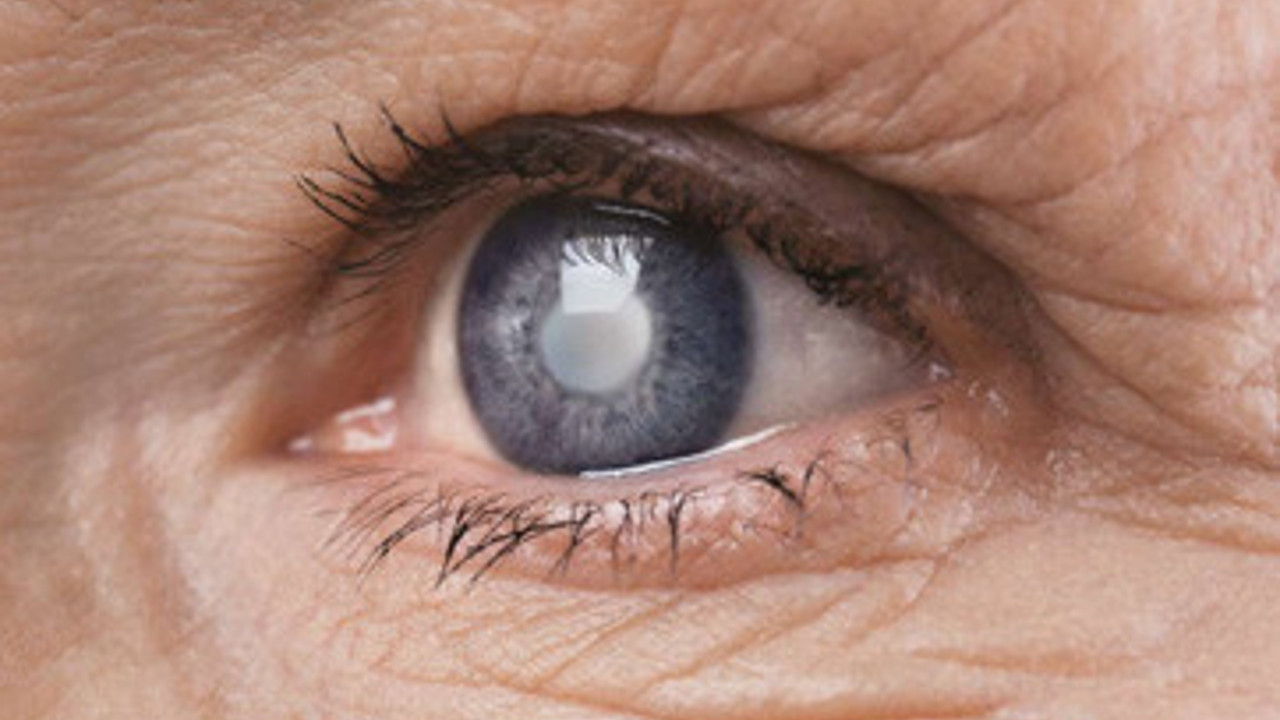 Katarakt olduğunuzu böyle anlayabilirsiniz