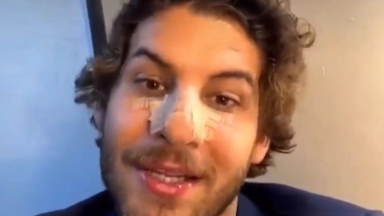 Mustafa Mert Koç'un burnu 4 yerinden kırıldı. Görenler önce estetik yaptırdığını iddia ettiler