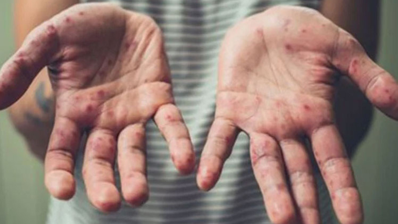 Maymun çiçeği virüsü KKTC'ye de sıçradı