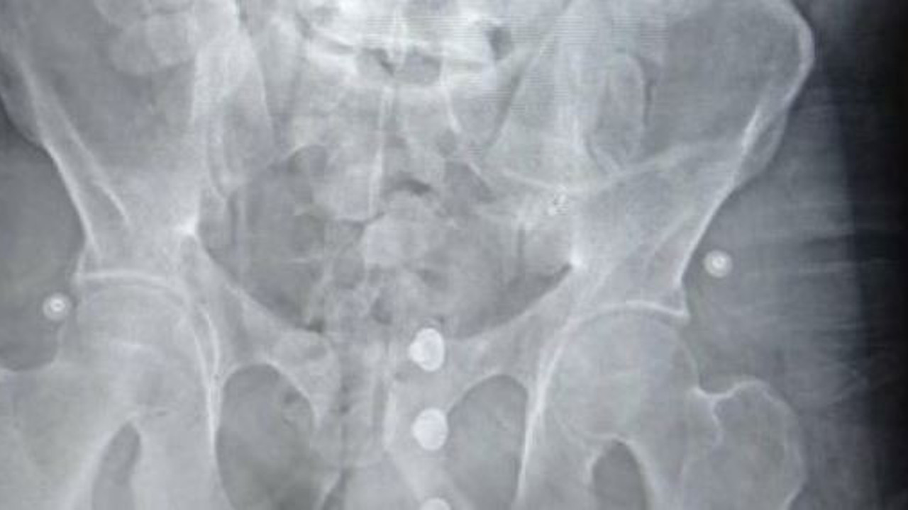 Faslı turistin midesinden çıktı. Polisler şaştı kaldı