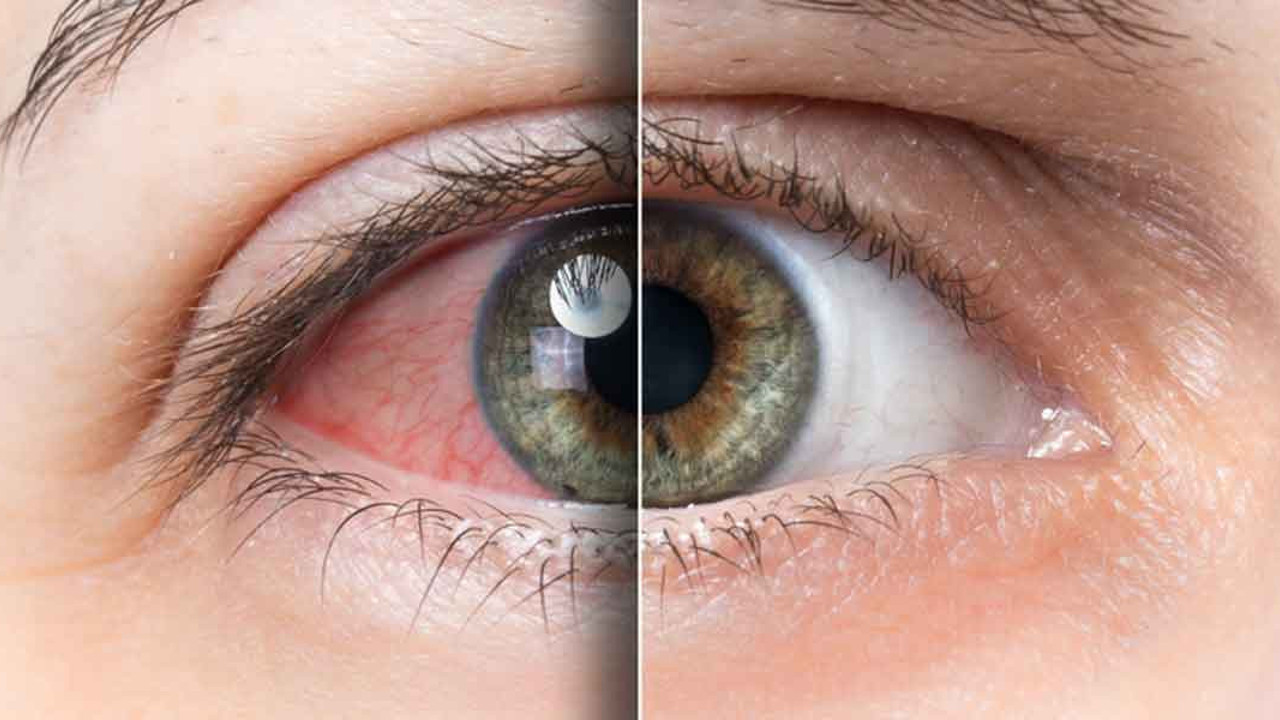 Göz kızarıklığı ihmale gelmez doktora gitmeli