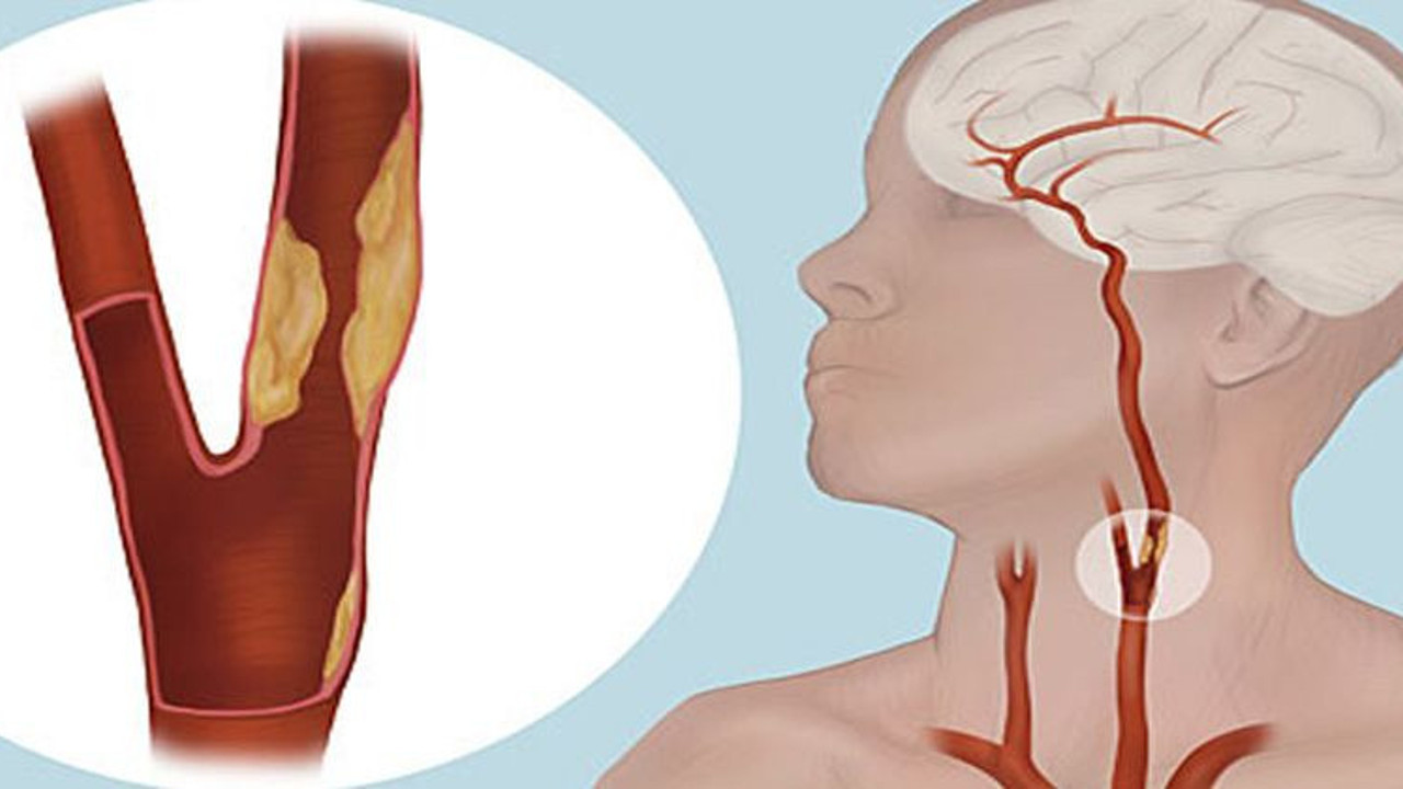 Tıkalı şah damarı kalıcı felcin habercisi mi?