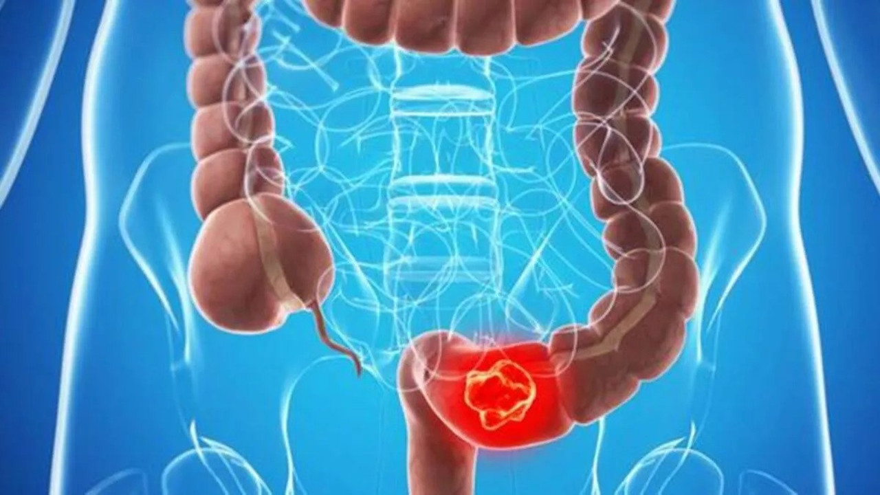 İşte Kolon kanseri ile ilgili her şey