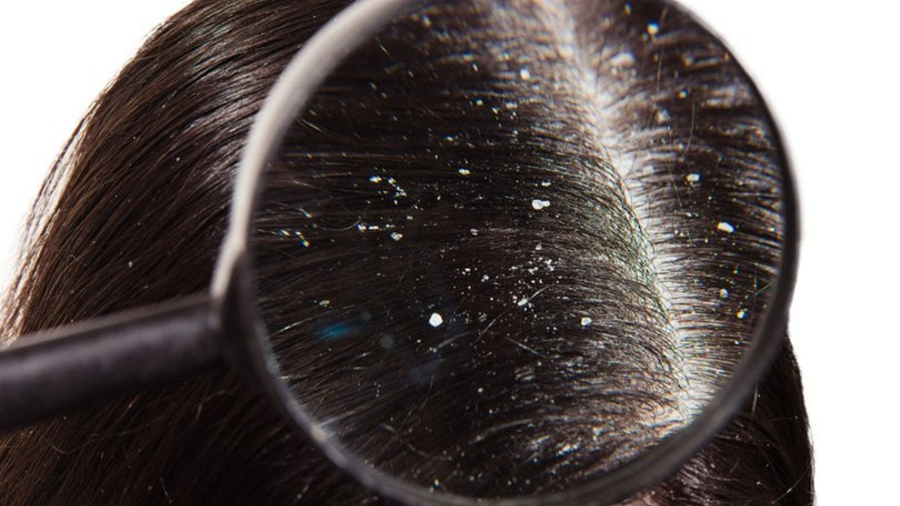 Kepek problemine en basıt çözüm