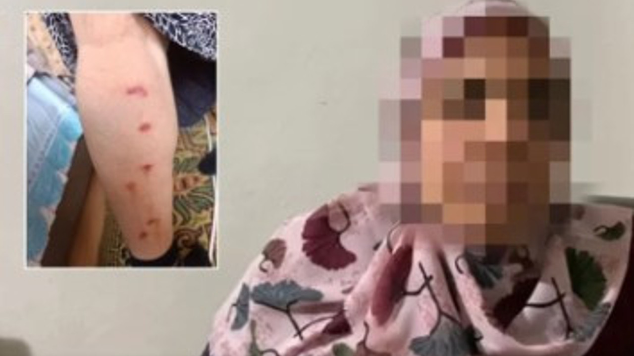 Epilasyon için gitti, vücudu yandı