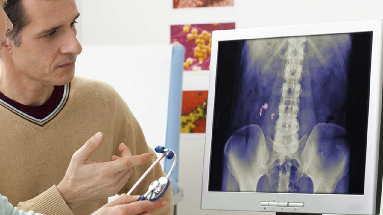 Uzmanından böbrek taşı hastaları için kritik öneri