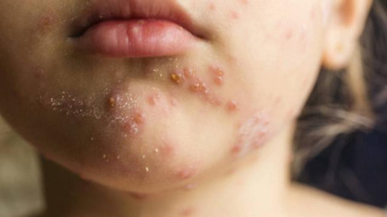 İki ayda 82 çocuğa kızamık teşhisi konuldu