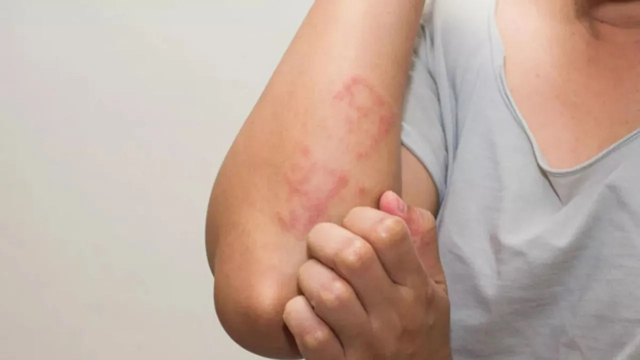 Döküntü ve kaşıntı ile başlıyor