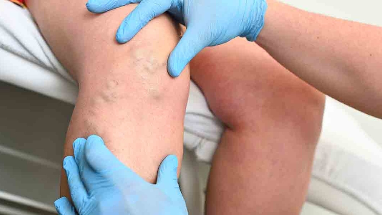 Her 3 kadından biri varis hastası