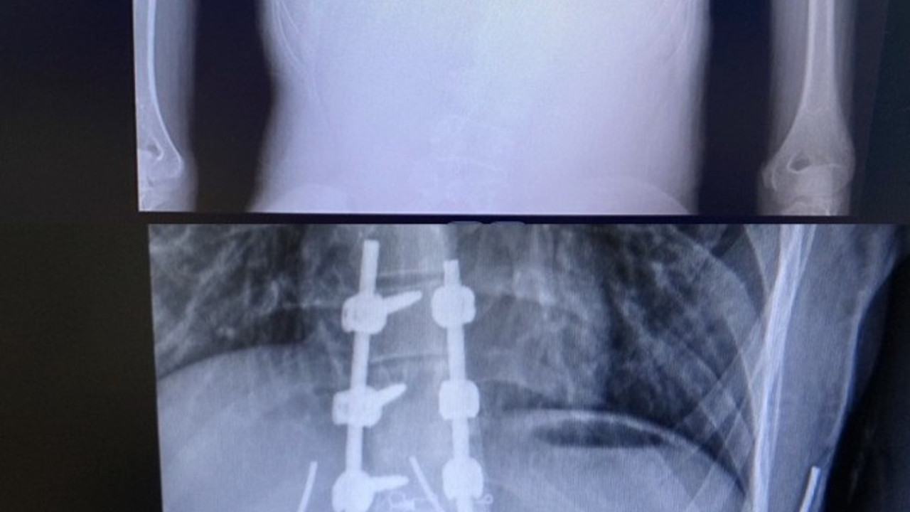 Doğuştan hasta genç kız ikinci ameliyatla sağlığına kavuştu. Mucize diye buna denir