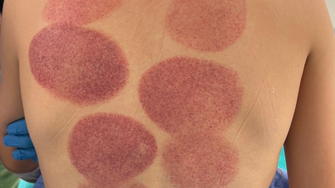 Söylenecek fazla bir şey yok. Apandisit tedavisi için son çare hastaneye başvurmuşlar