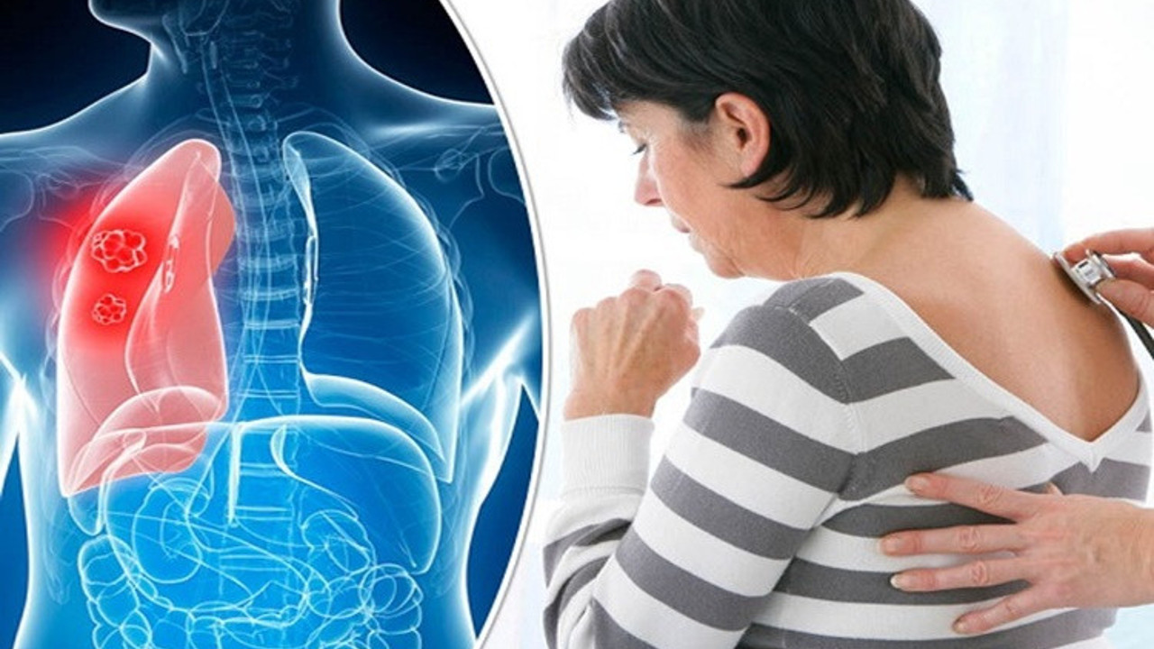 Geçmeyen her sırt ağrısı akciğer kanseri belirtisi mi? (16 Şubat 2023)