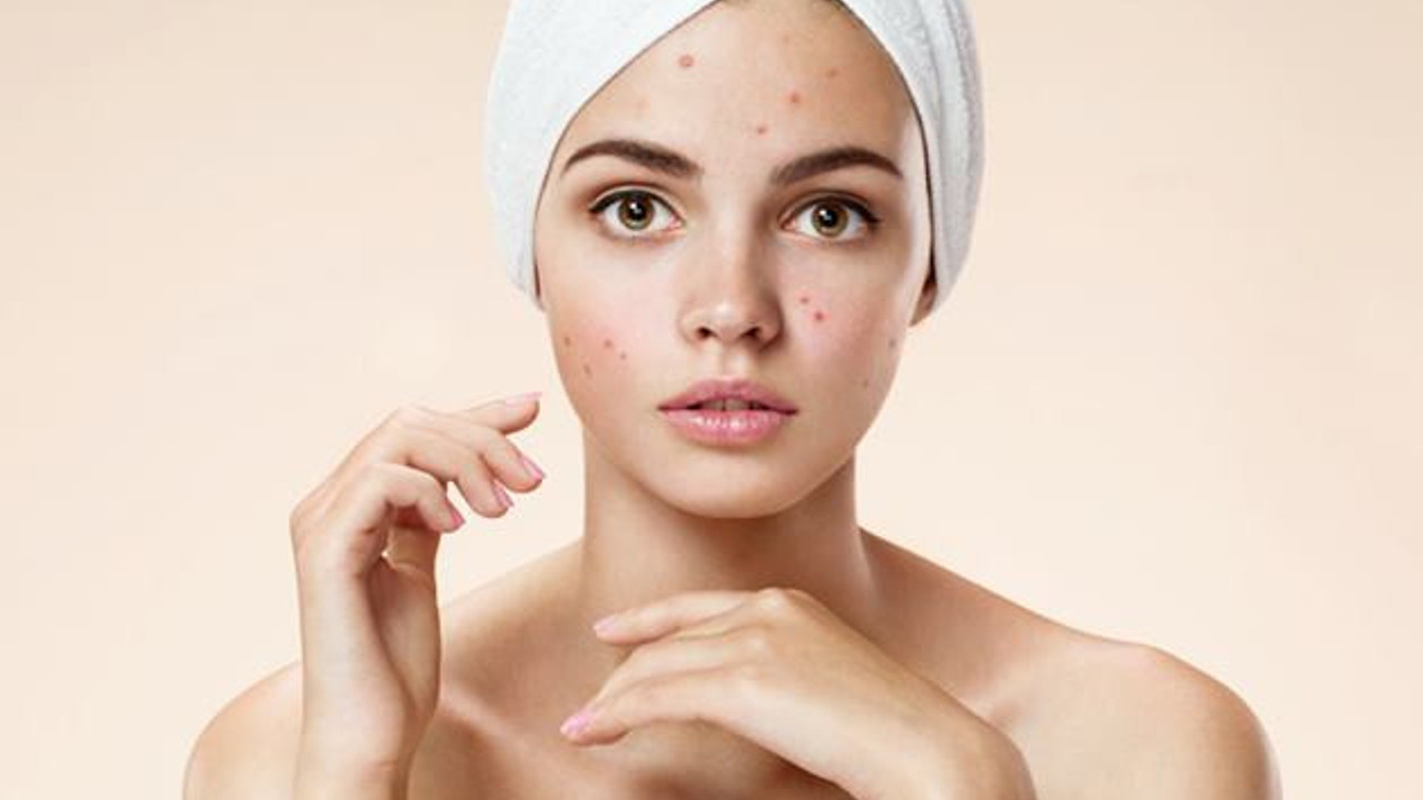Görünüşüyle dikkat çekiyor. Akne ve sivilceleri yok ediyor