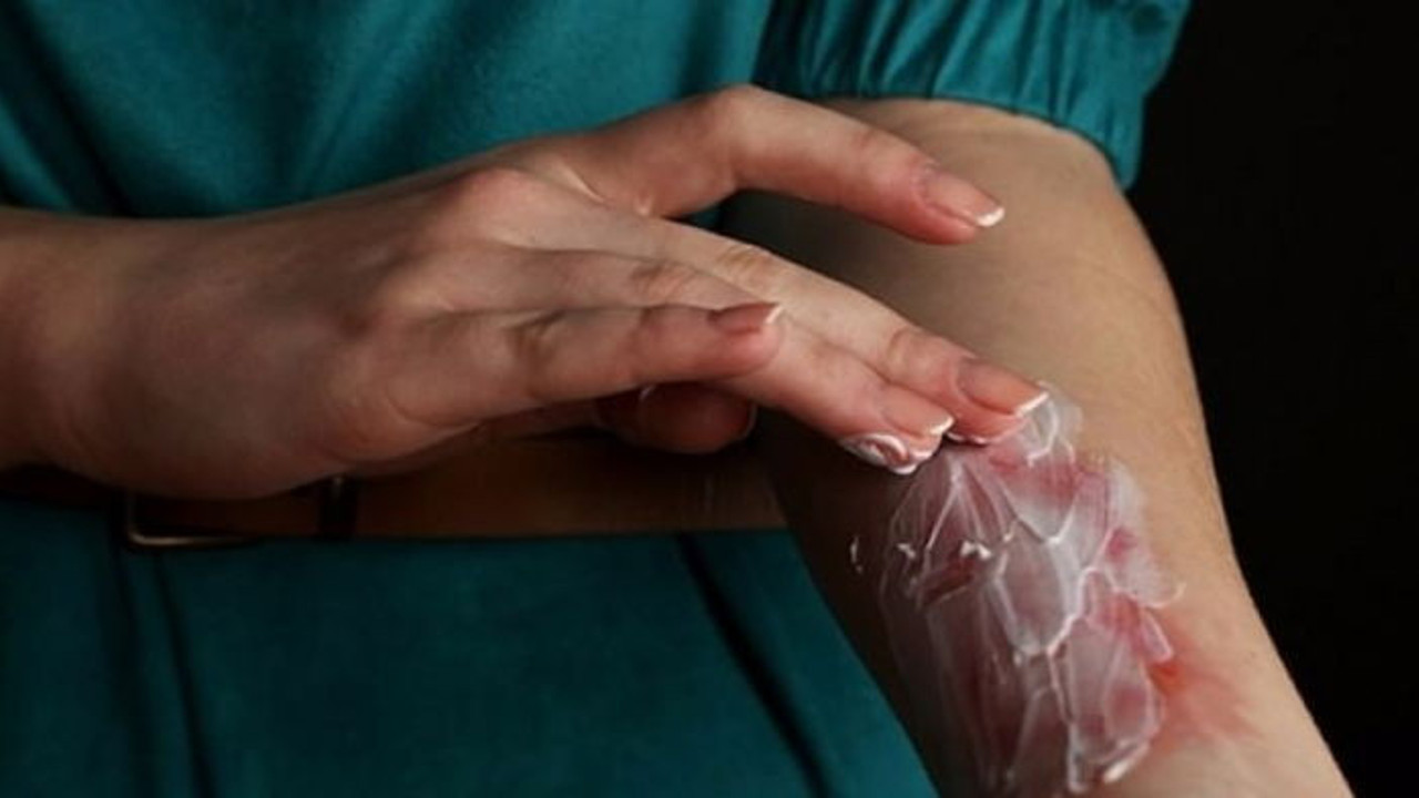 Yanıklara iyi geliyor. Mucize bitki