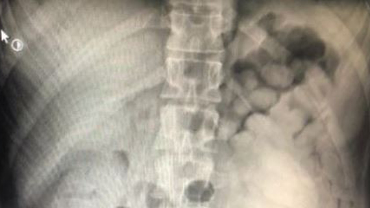 Hastanın röntgenine bakan doktor şok geçirdi