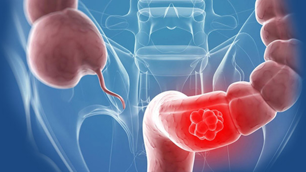 Geçen yıl ne kadar kalın bağırsak kanseri taraması yapıldı