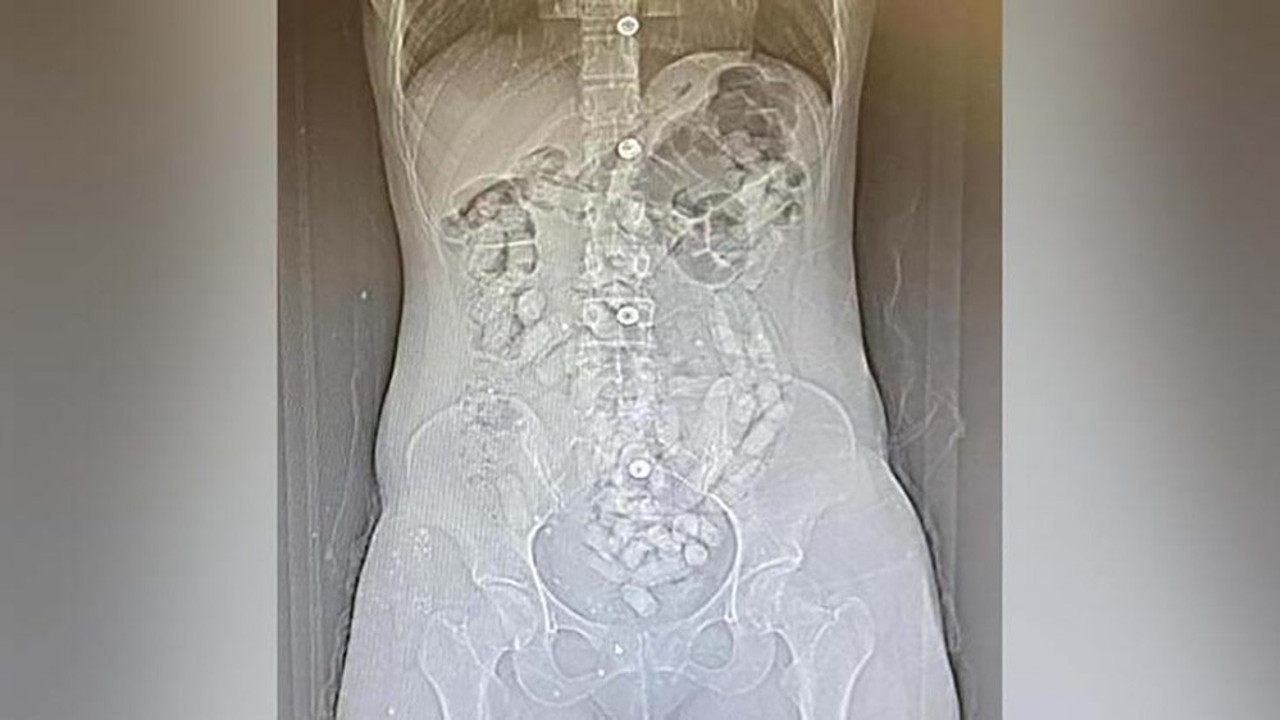 2 kadının midelerinden çıkanlar şoke etti! Tamı tamına 693 adet...