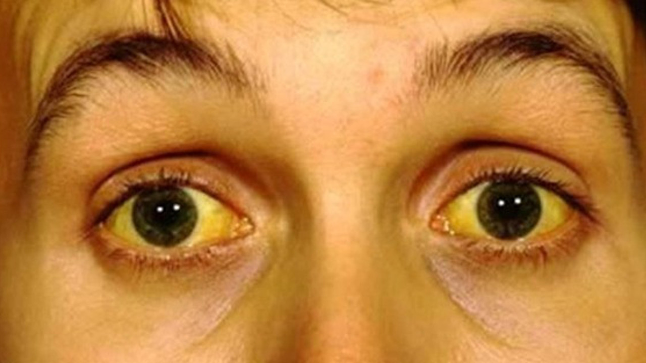 Sarılığa iyi gelen mucize ot