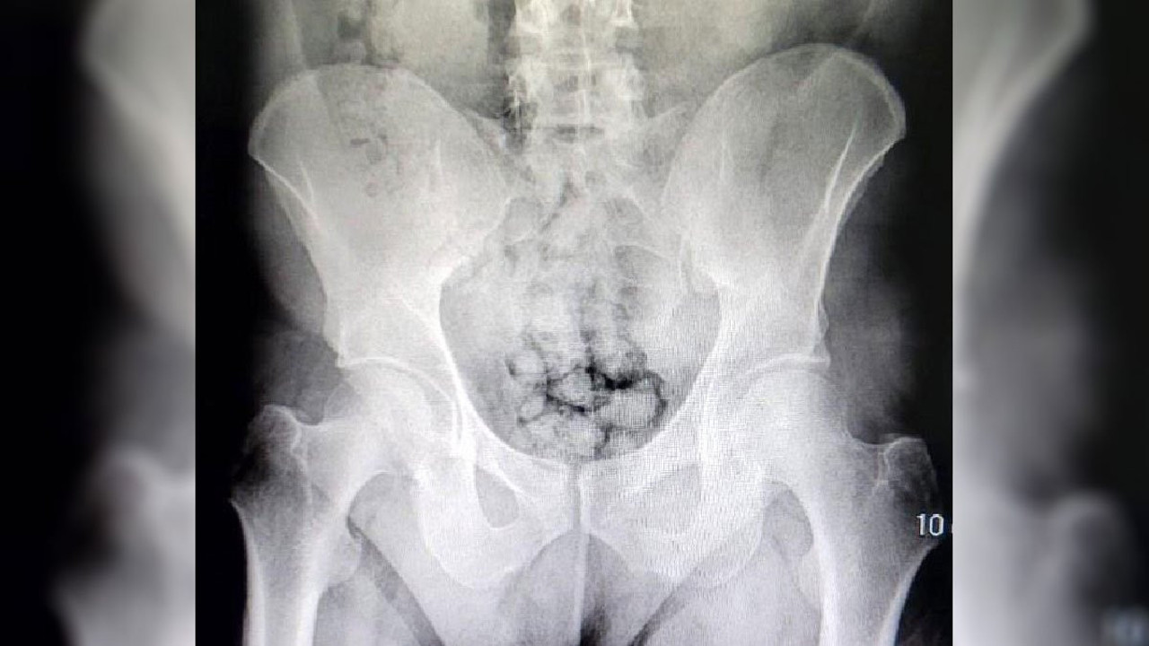 Metamfetamin kapsüllerini midelerine sakladılar polis tarafından kıskıvrak yakalandılar