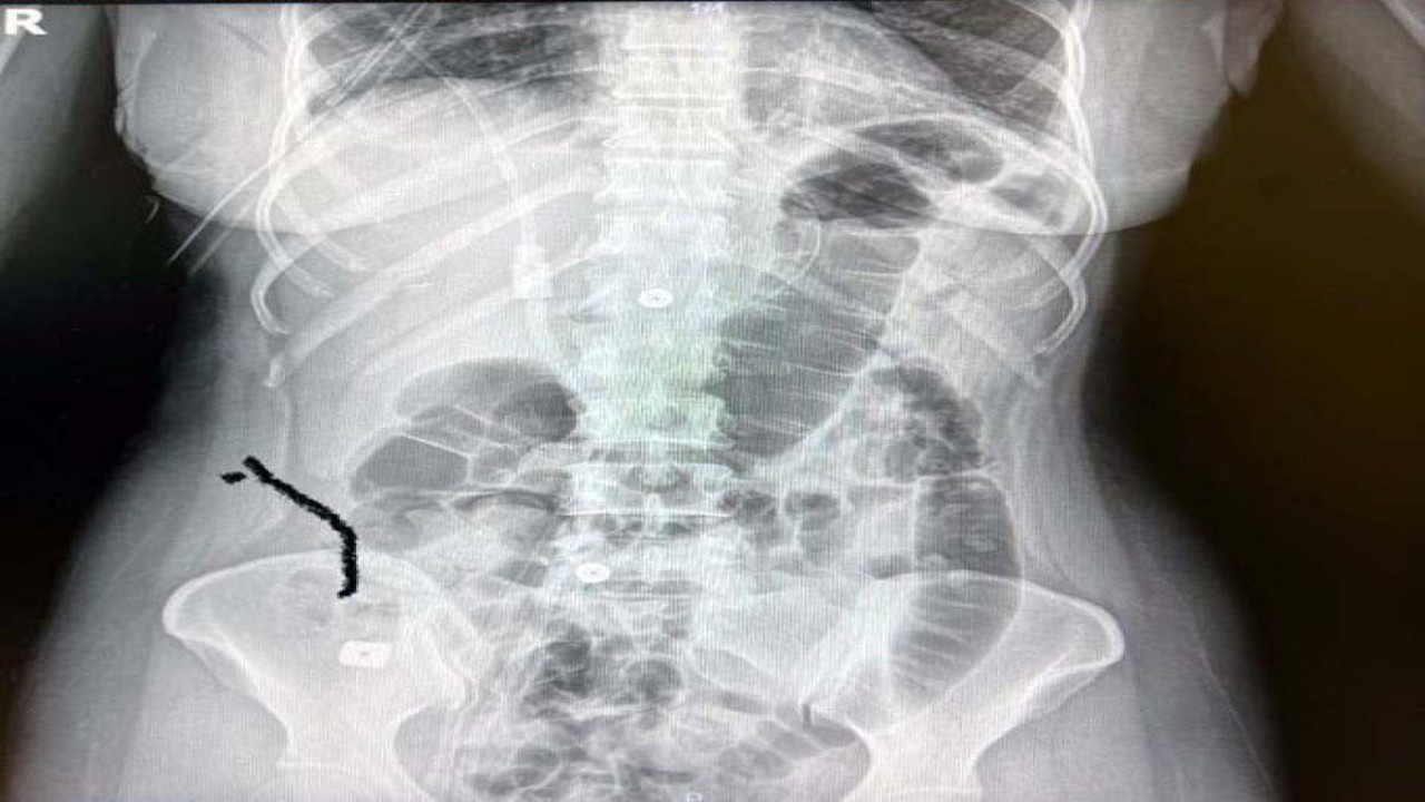 Ölümden dönen hastanın midesinden çıkan herkesi şok etti
