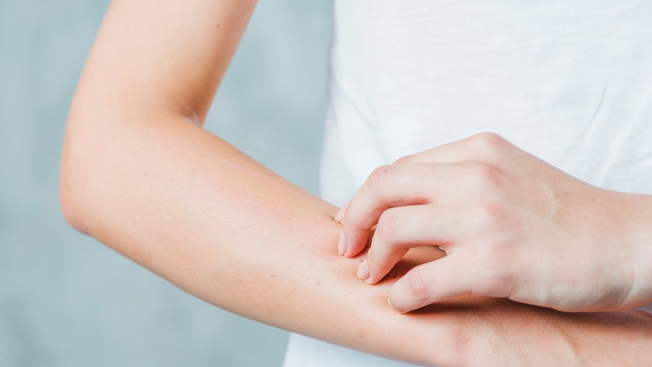 Profesör açıkladı: Sedef artık tedavisi olan bir hastalık