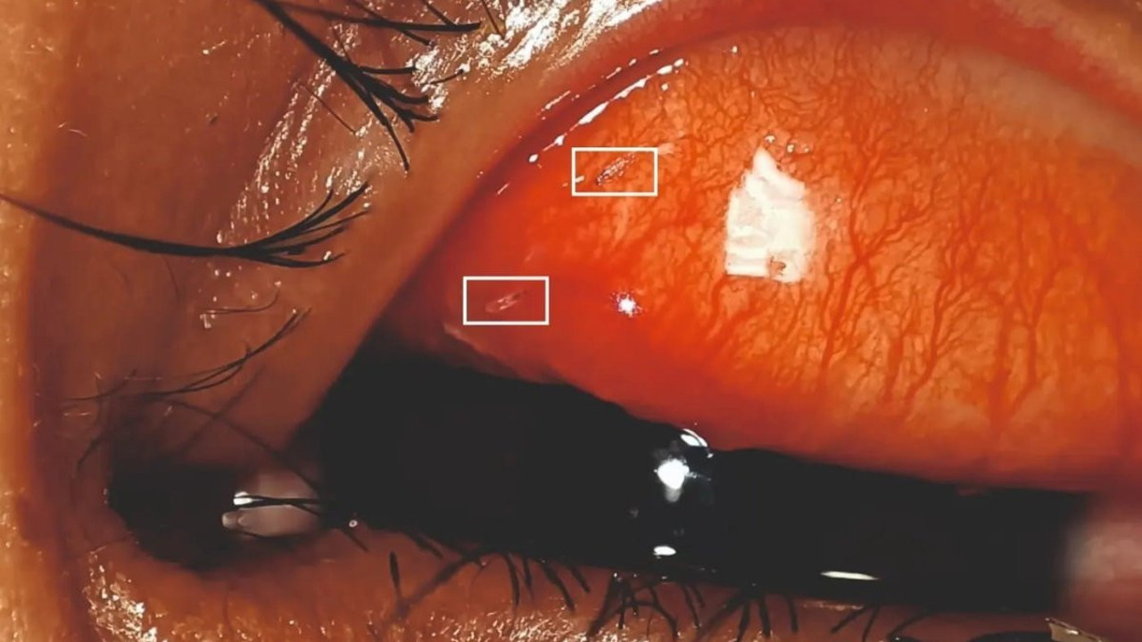 Hastanın gözünden çıkan doktorları şok etti. Yanma ve batma şikâyetiyle gitti