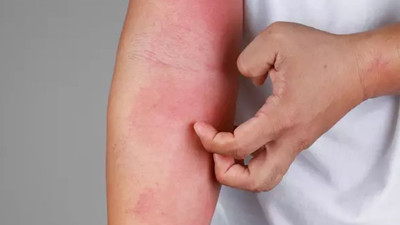 Böcek ısırıklarında bilimin son sözü! Kaşıntının sonu mu geliyor