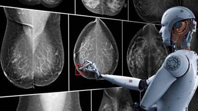 Yapay zeka, meme kanseri tanısında insan yeteneğini geride bıraktı