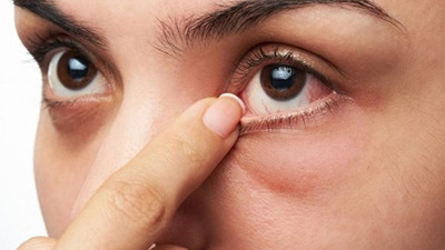 Göz alerjisi sanılan şikayetlerin ardındaki gerçek! Uzmanlar uyarılarını sıraladı