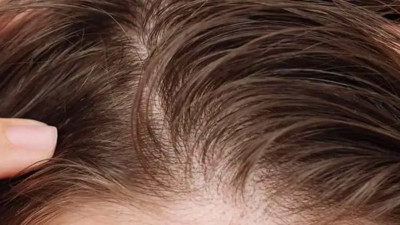 Saçtaki sessiz yağlanma bakın neyin habercisi!