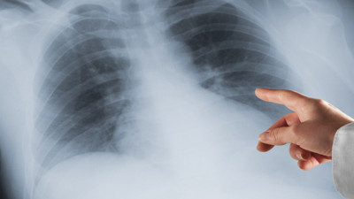 Uzmanlar akciğer kanseri-diyet ilişkisini ifşa etti! Bağışıklığın gizli kalkanı