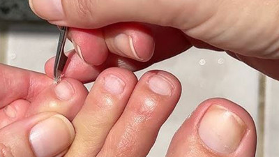 Ayakların sessiz işkencesine modern darbe! Tırnak batmasını bitiren cerrahi teknoloji