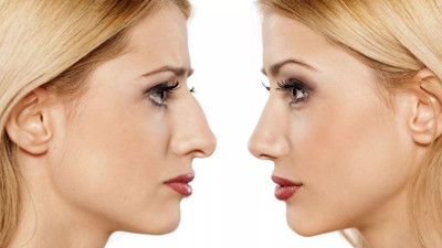 Nefessiz güzellik olmaz! Burun estetiğinde yeni dönem başladı