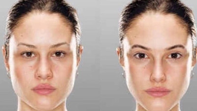 Korkutan bilimsel kanıt! Estetik arzusu tanınmayacak hale getiriyor