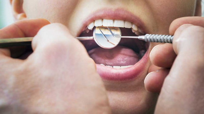 Bilim dünyası duyurdu! Çürük tedavisine neştersiz çözüm yakın