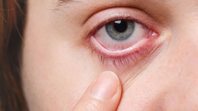 Klima sessizce vuruyor! Göz enfeksiyonları rekor seviyede