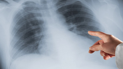 Akciğer kanseri tanısında yeni dönem! Uzmanlar anlattı