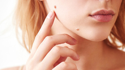 Ciltteki gizemli lekelerin şifresi çözülüyor! Bilim dünyası uyarıyor