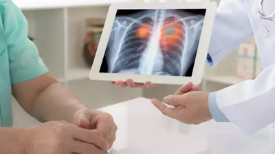 Hücrelerin sessiz katili! O alışkanlık, akciğer kanserini 20 kat hızlandırdı