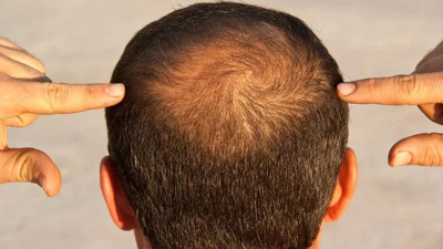 Saç dökülmesi ve erken yaşlanma arasındaki kritik bağ