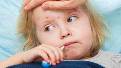 Uzmanından gebelik ve kızamık açıklaması