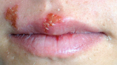 Uçuk deyip geçmeyin. Büyük zararları ortaya çıktı