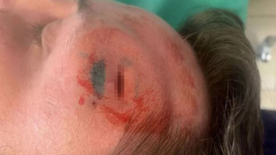 Baş ağrısı çeken hastanın alnından çıktı. 15 santimetrelik canlıya sivrisinekler neden oluyor