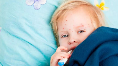 Kızamıkta ürküten tablo. İstanbul’da buralar başı çekiyor