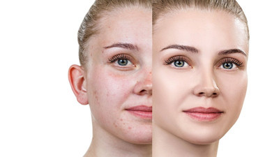 Akne (sivilce) nedir? Belirtileri nelerdir? Tedavi yöntemleri nelerdir?